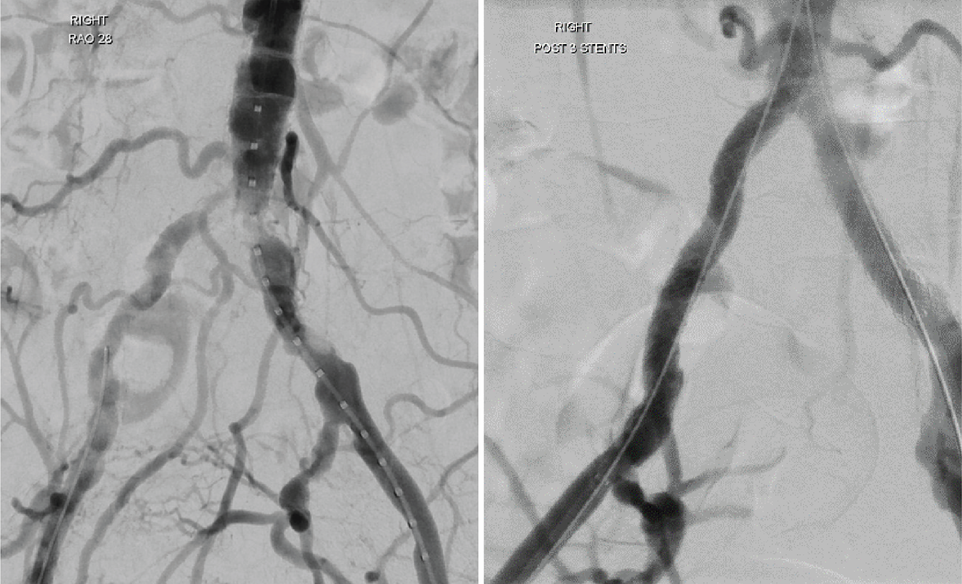 Before and after x-ray showing lumen diameter restoration